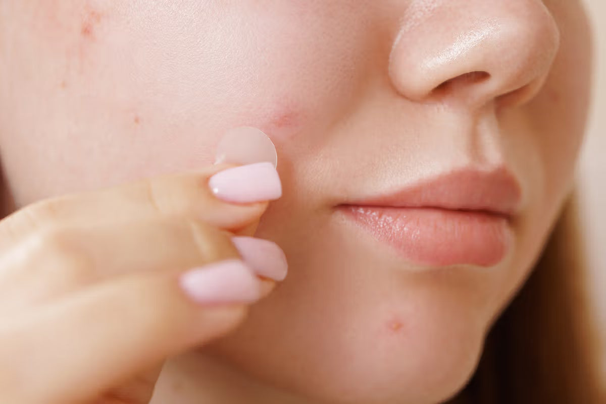 Everything You Need to Know About Korean Pimple Patches