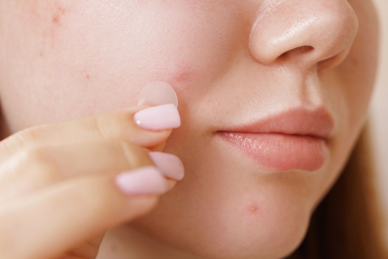 Everything You Need to Know About Korean Pimple Patches