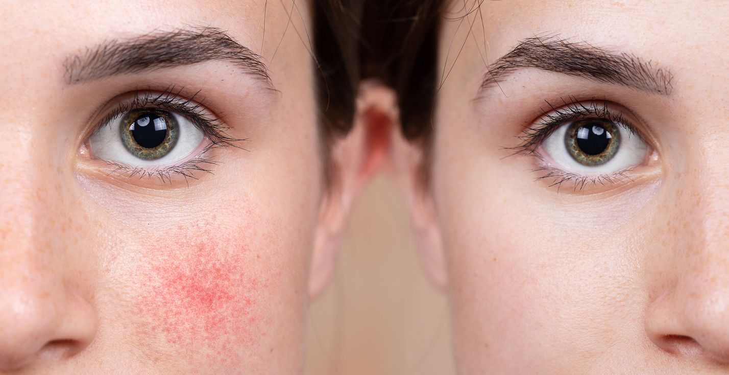 Two people side-by-side, one with reddened, textured cheeks and the other with smooth, clean skin