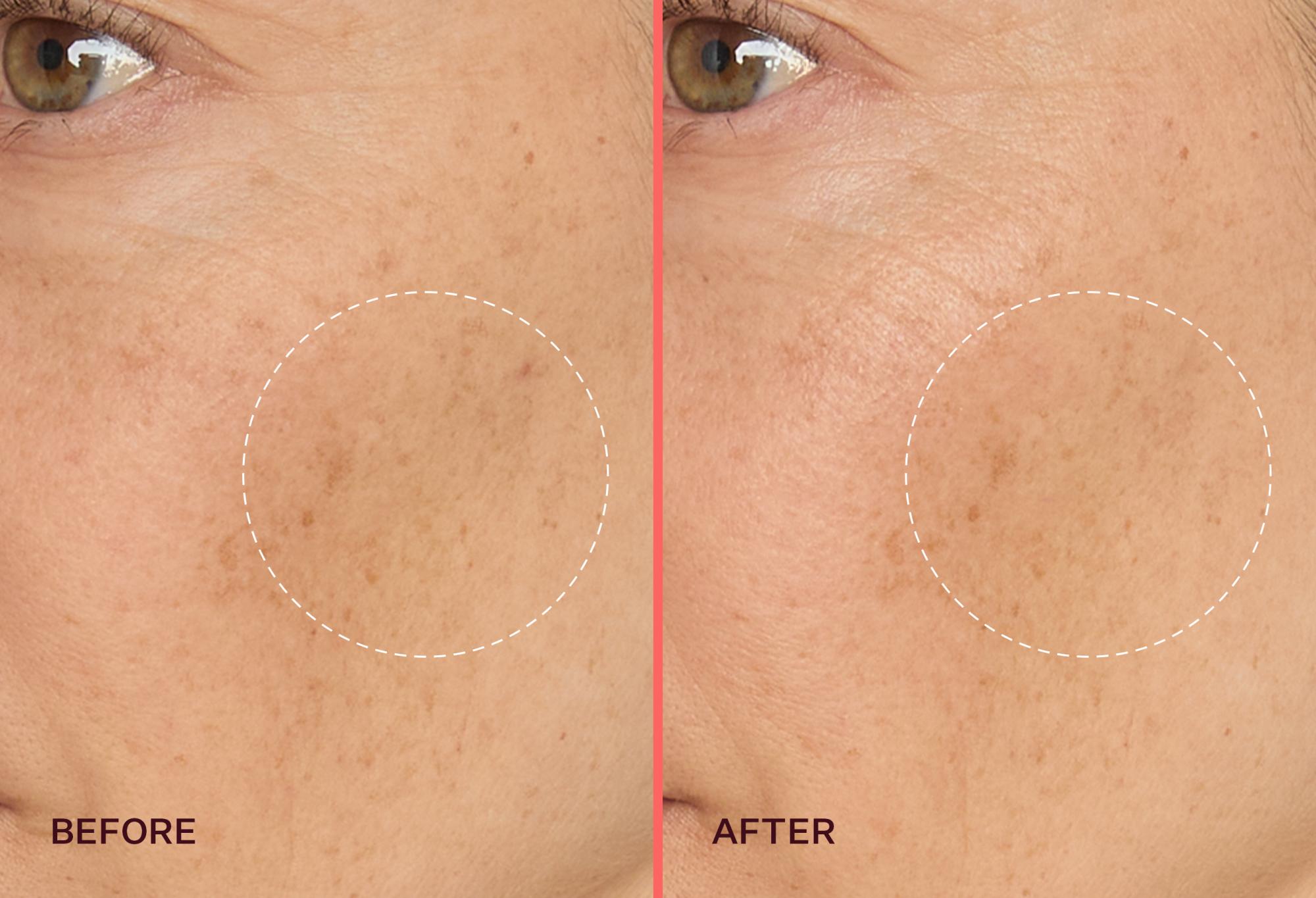 The Best Korean Skincare Products for Hyperpigmentation: A Comprehensive Guide