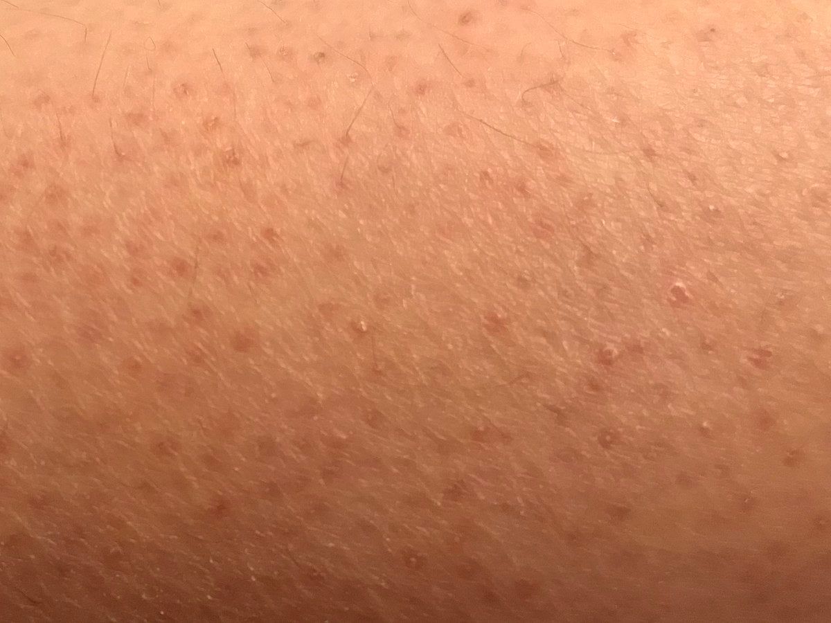 Everything You Need to Know About Keratosis Pilaris