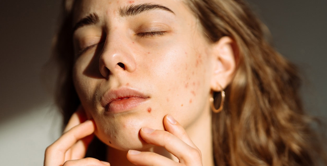 Why Your Skin Breaks Out More in Summer Heat