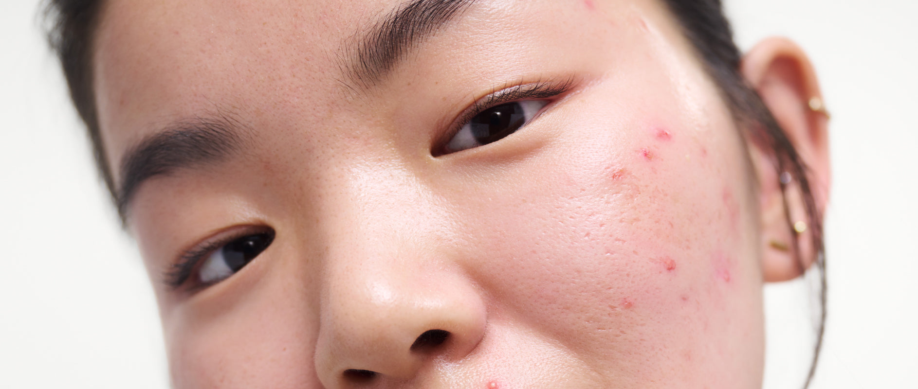 Peach & Lily Skin Concern - Inflammation