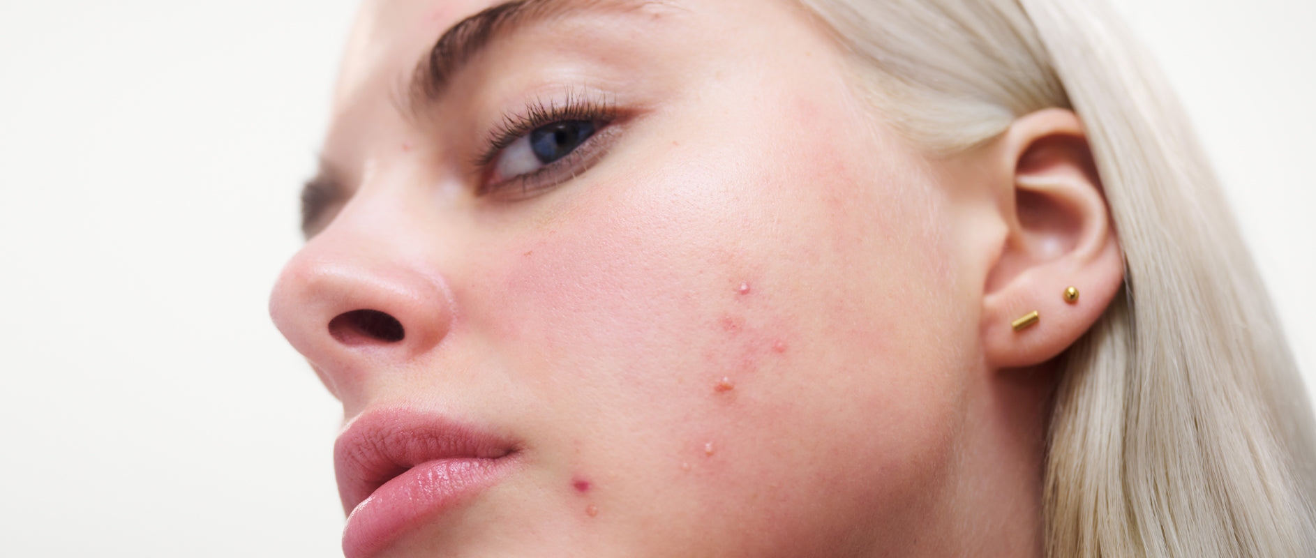 Peach & Lily Skin Concern - Acne
