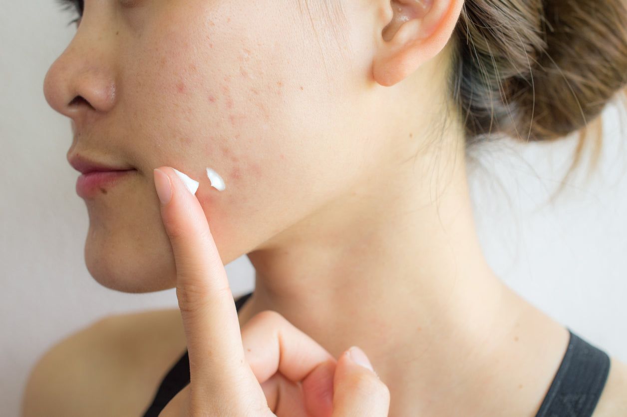 Peach & Lily - How to Get Rid of Acne
