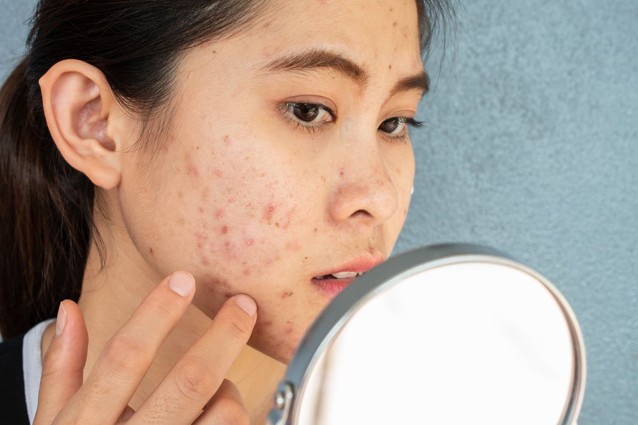 Peach & Lily - What Causes Adult Acne & How to Treat It