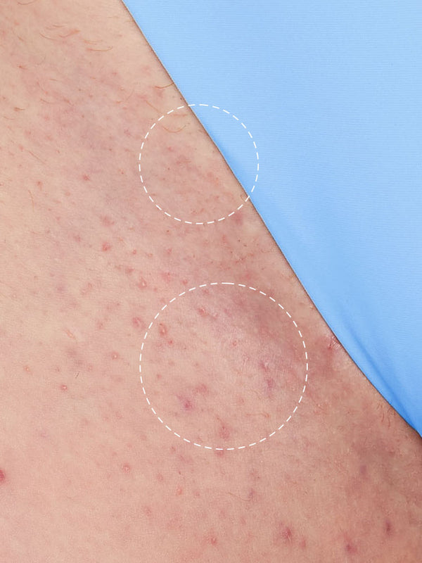 After using Evora Ingrown Hair & Bump-Free Roller