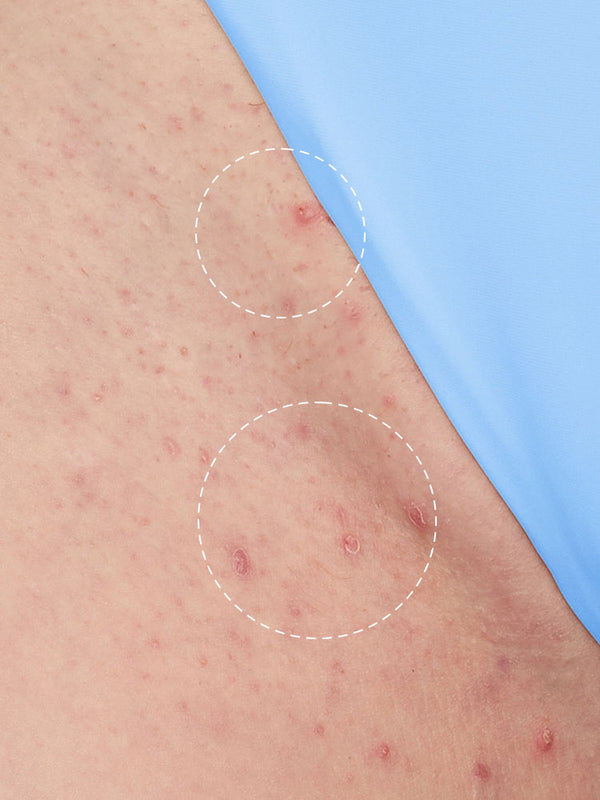 Before using Evora Ingrown Hair & Bump-Free Roller